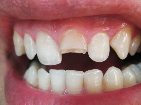 Chiêm nghiệm nằm mơ thấy gãy răng là điềm gì, số gì may?